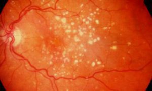 retina-y-macula-1