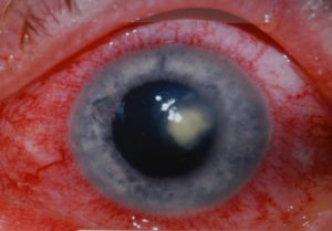 Ulcera corneal
